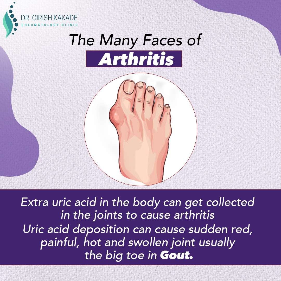 Best Rheumatologist in Pune | | Dr. Girish Kakade